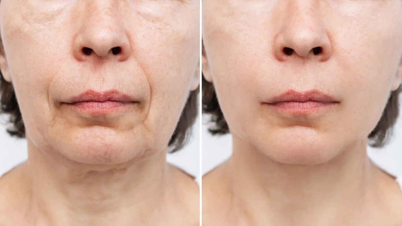 Facial contouring