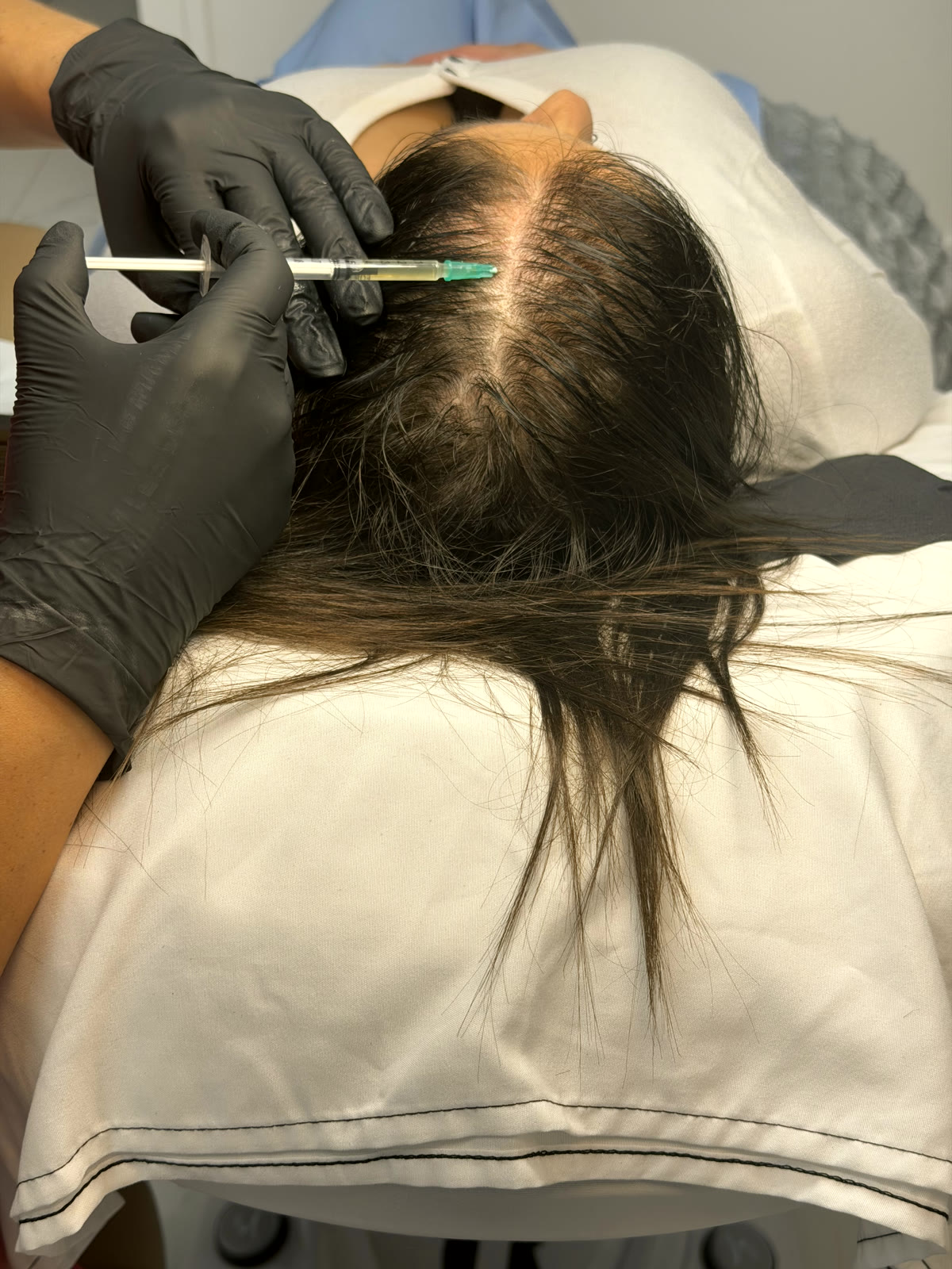 PRP for Hair