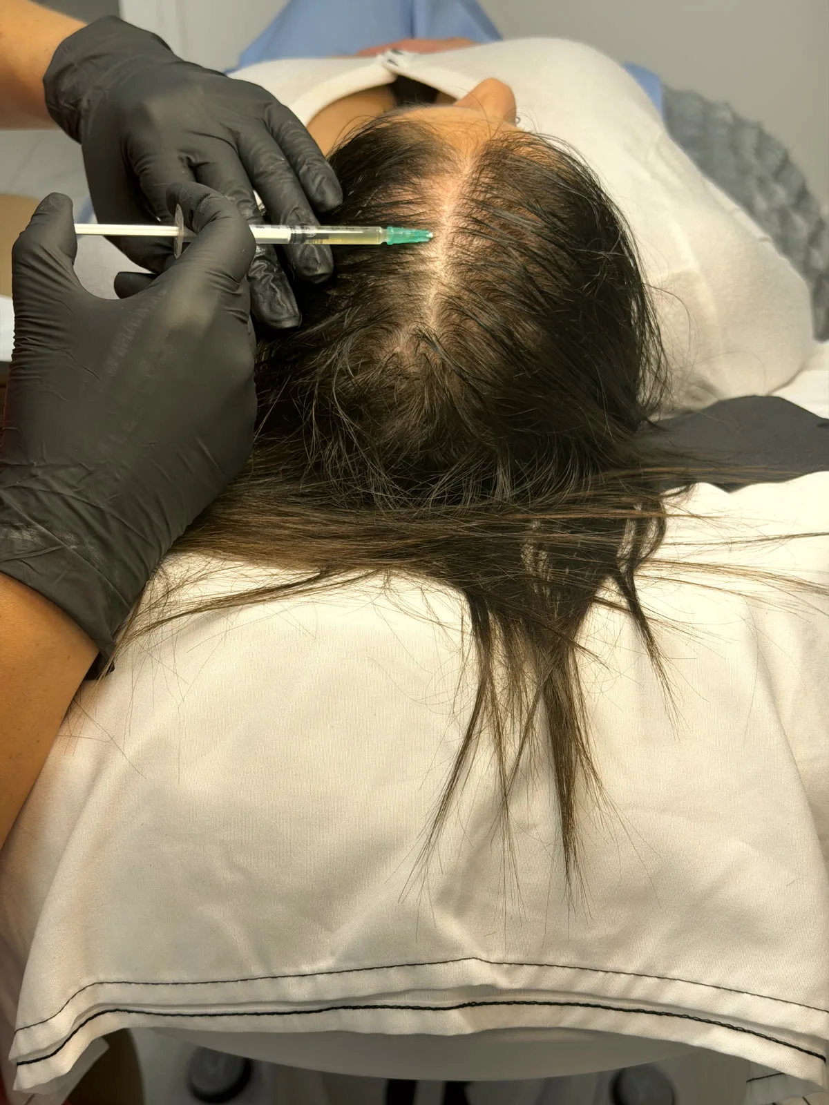 PRP for Hair