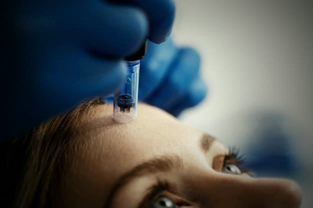 Microneedling y PRP