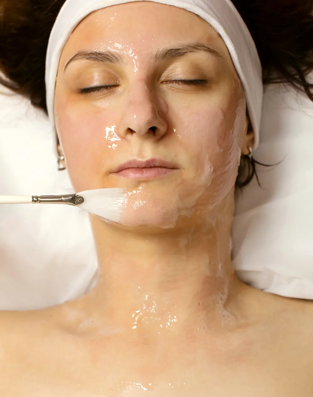 Chemical Peels