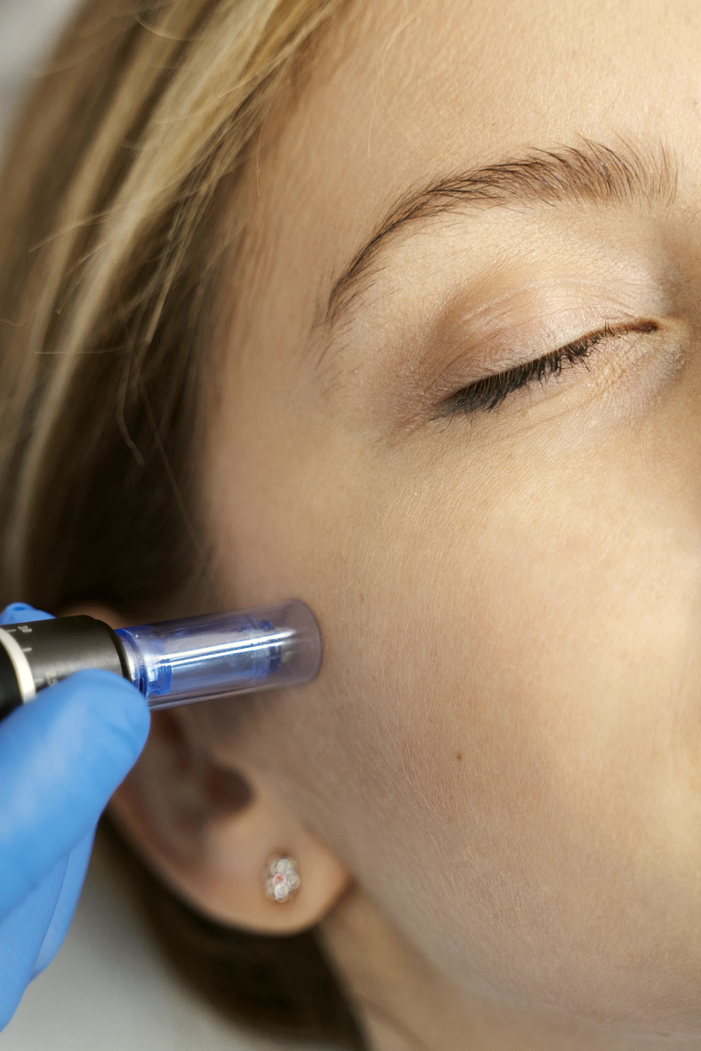 RF Microneedling